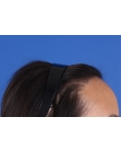 After Hair Transplant&nbsp;Hairline